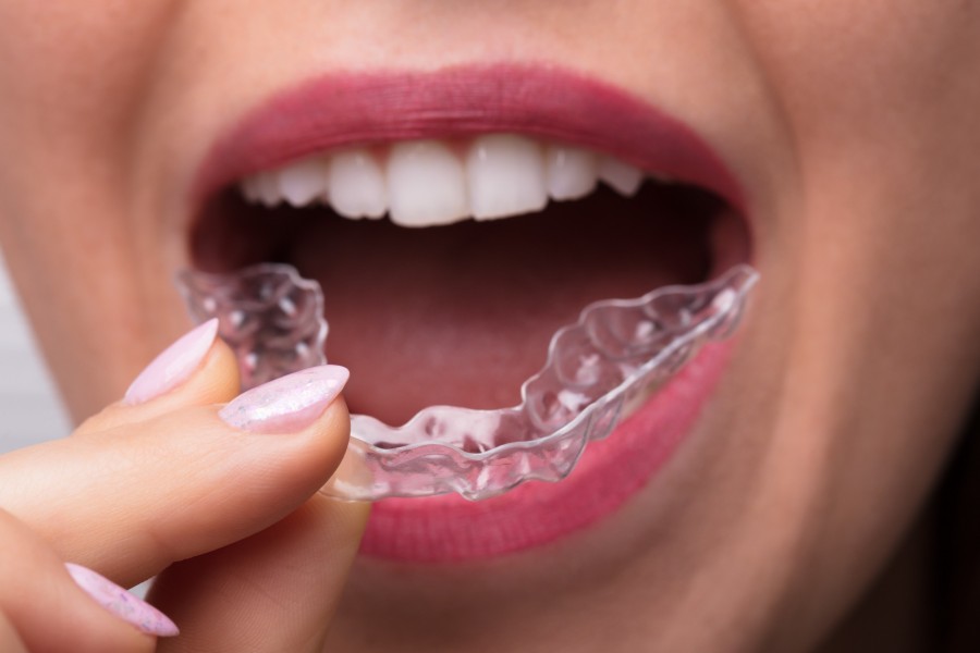 Quels sont les avis des patients sur Invisalign avant et après traitement ?